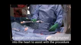 PFO closure - Premere. Sharpe Cardiology and Endovascular