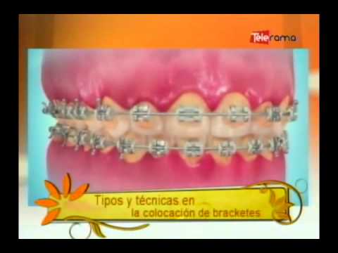 Tipos y técnicas en la colocación de bracketes