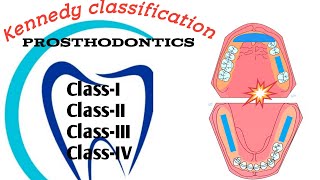 Kennedy's classification and Applegate's rule || Dentophile
