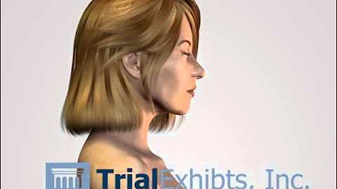 Coup and Contracoup Injury - Traumatic Brain Injury 3D Animation