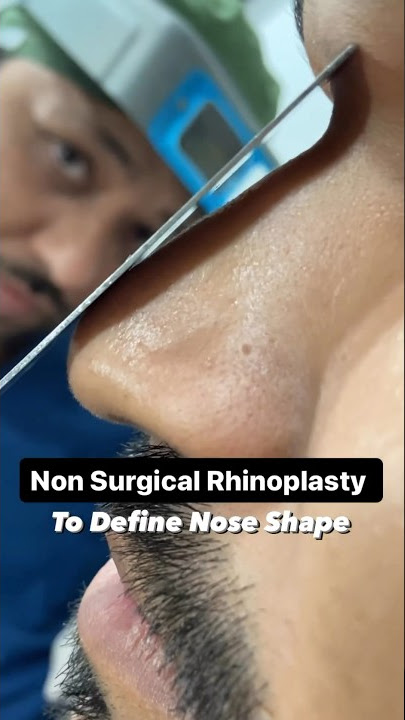 Non Surgical Rhinoplasty : To Define Nose Shape !  #nonsurgicalrhinoplasty