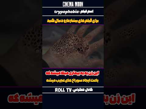 این زن به یه بیماری مبتلا میشه که باعث ایجاد سوراخ های عجیب میشه