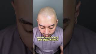 SMP Breakdown: Fixing Bad Work After Laser Tattoo Removal | 3-Session Game Plan screenshot 5