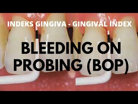 Video: Dalam indeks pendarahan gingival?