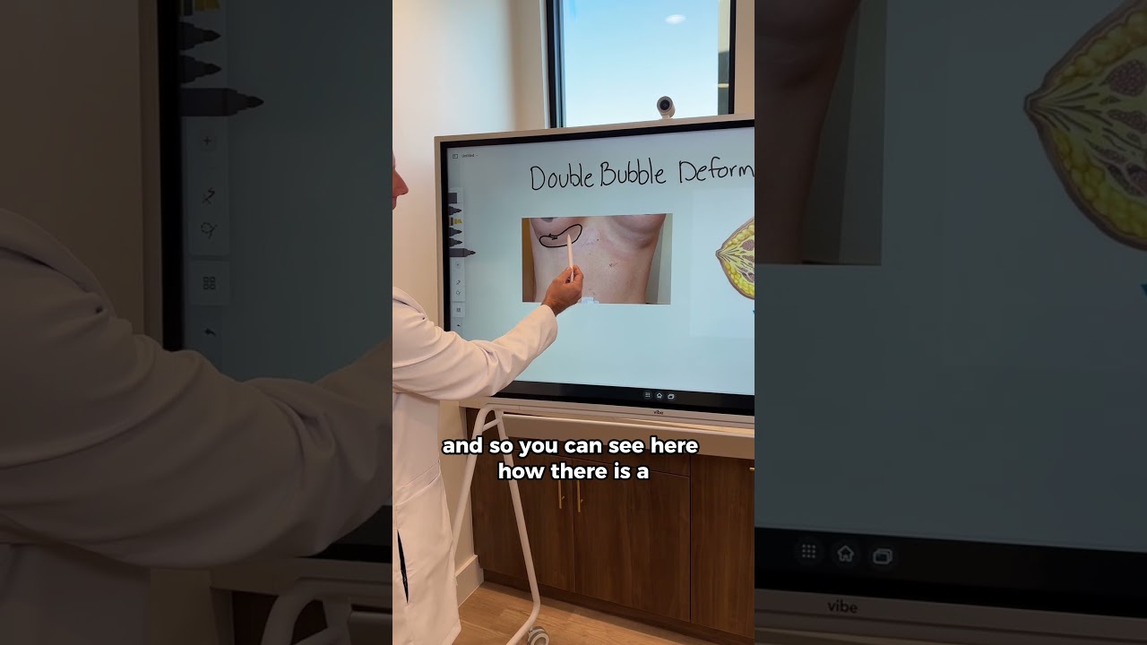Double Bubble Deformity Breast Augmentation