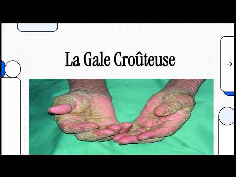 Crusted Scabies