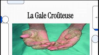 La Gale Croûteuse
