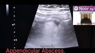 Appendicular Abscess./ appendiceal abscess / appendicular / appendiceal abscess ultrasound