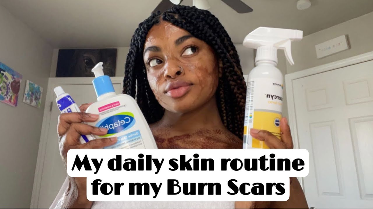 My Daily Skin-Care Routine for my Burn Scar + Update