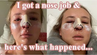 WHAT IT’S REALLY LIKE DAYS 1-7 // MY SEPTOPLASTY & RHINOPLASTY JOURNEY - Pt 1