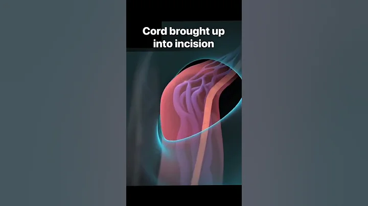 Microscopic varicocelectomy