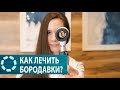 Как лечить бородавки?