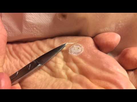 Removal of foot plantar wart with acid part 2/3