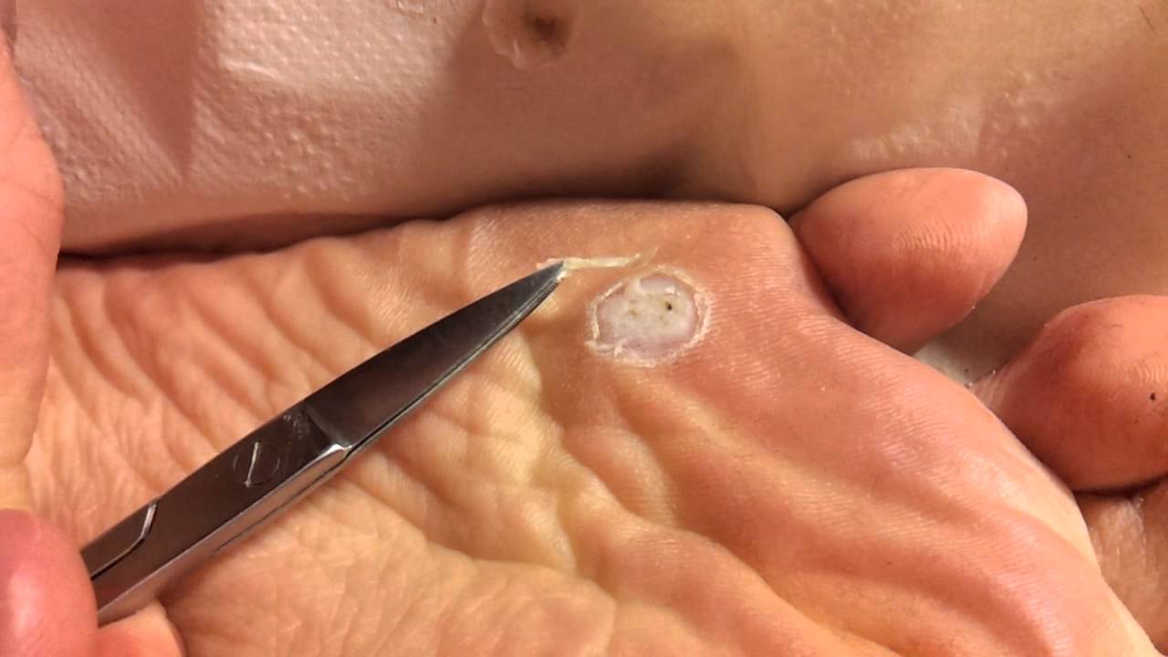 Removal of foot plantar wart with acid part 2/3 YouTube