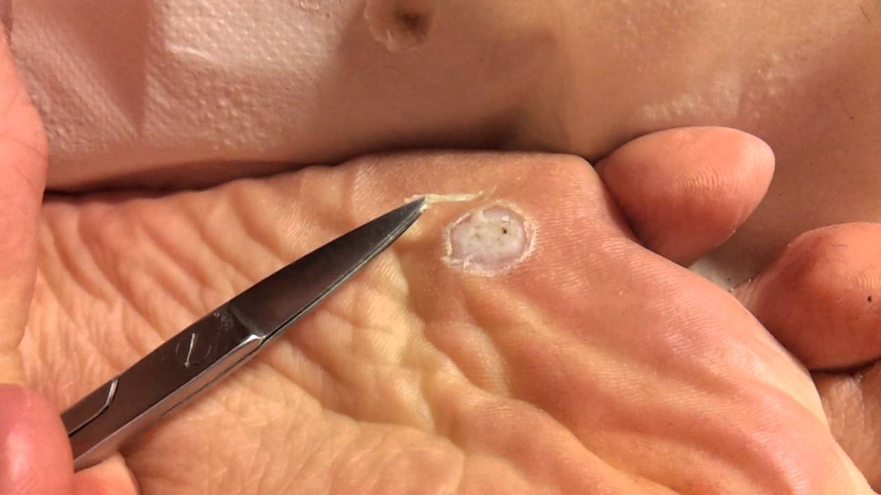 Removal Of Foot Plantar Wart With Acid Part 2 3 YouTube