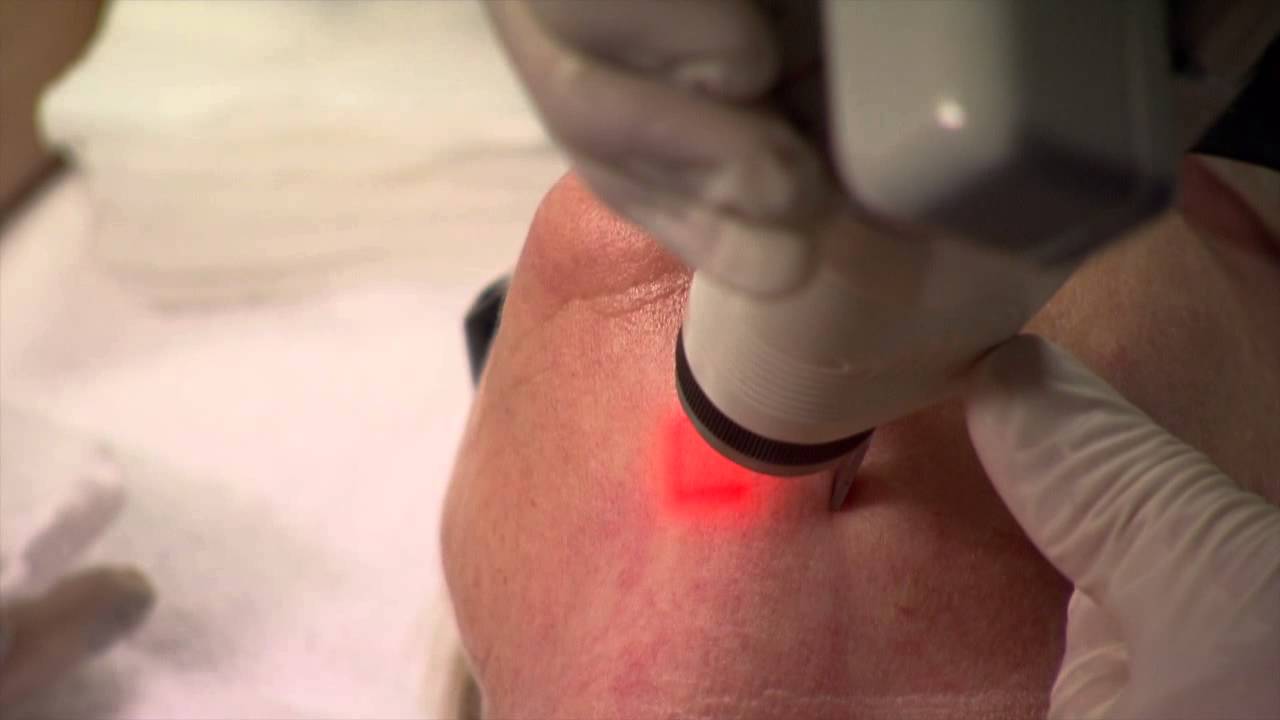 Neck Rejuvenation — Ultrapulse Fractional CO2 Laser Active FX — Laser