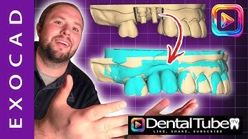 Exocad 3.2 How To Align A Preop Tutorial 