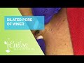 Dilated Pore of Winer