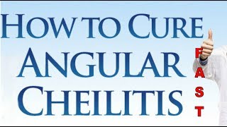 Angular Cheilitis Overnight Cure Angular Cheilitis Cream