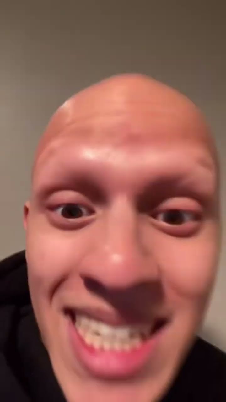 I’m NOT BALD! #comedy #funny #lol #alopecia