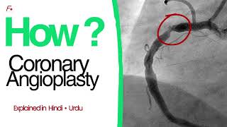     Coronary Angioplasty (PCI) Explained Step by Step | Hindi/Urdu