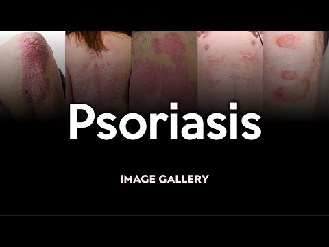 Psoriasis: Image Gallery