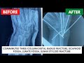 Comminuted Three-Column Distal Radius Fracture, Scaphoid Fossa, Lunate Fossa, Ulnar Styloid Fracture