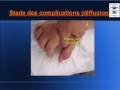 Panaris: Définition Complication et Conduite à Tenir traitement Panaris: Définition Complication et Conduite à Tenir traitement
