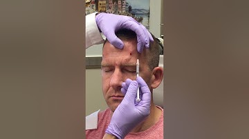 Botox Injection for Chronic Migraine