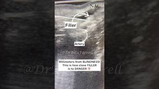 #vascularocclusion #blindness #filler #cannulatechnique #ultrasoundguidedfiller #drbitafarrell