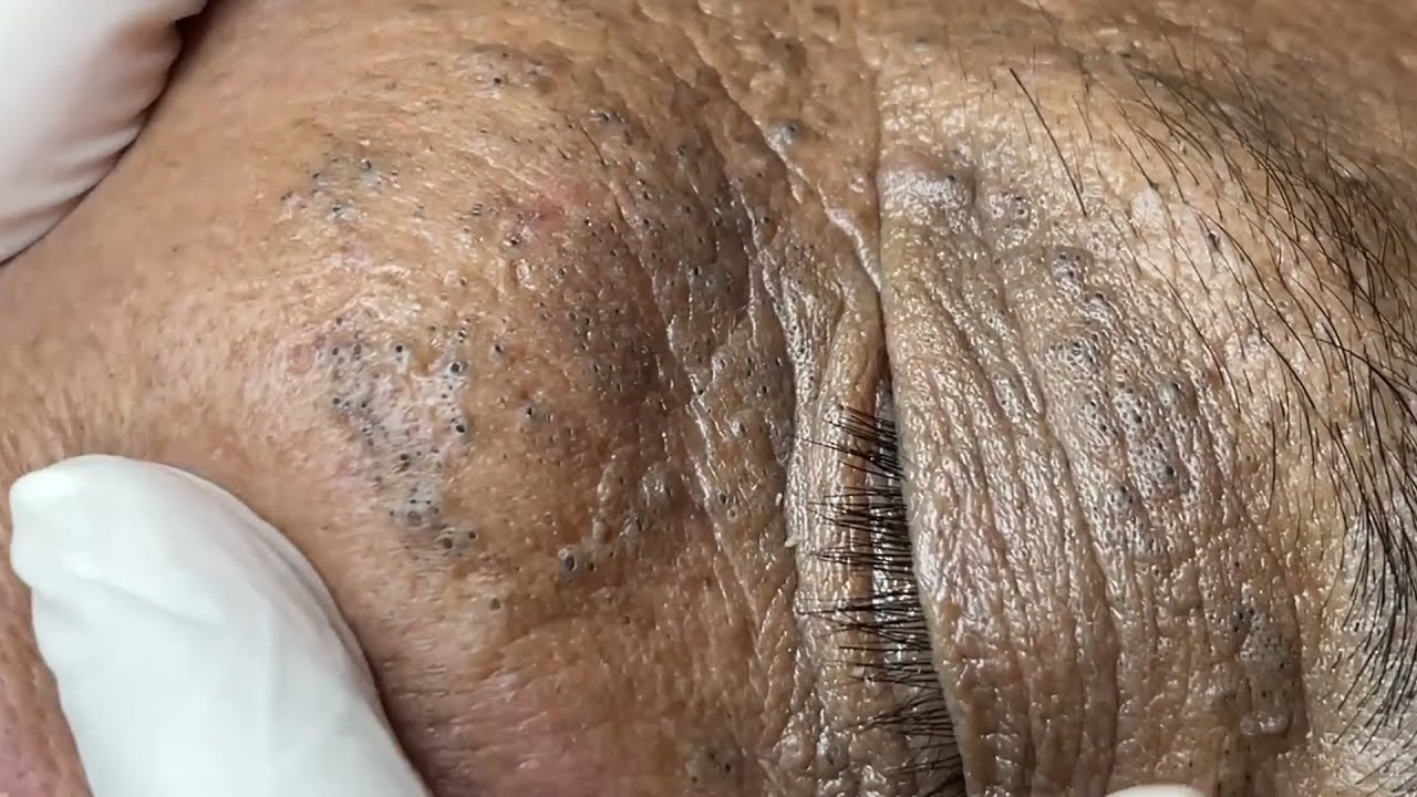 Satisfying Relaxing With Super Big Blackheads 3 YouTube Satisfying relaxing with super big blackheads 3 youtube