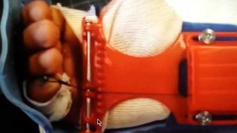 Dorsal Blocking Splint for FTR