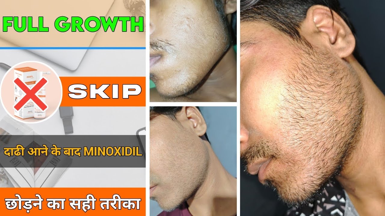 Minoxidil & Beard Growth: How to Stop Beard Regrowth After Stopping Treatment