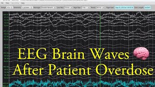 EEG Brain Waves After an Overdose