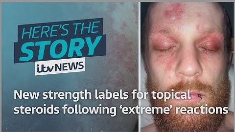 New strength labels for topical steroids following 