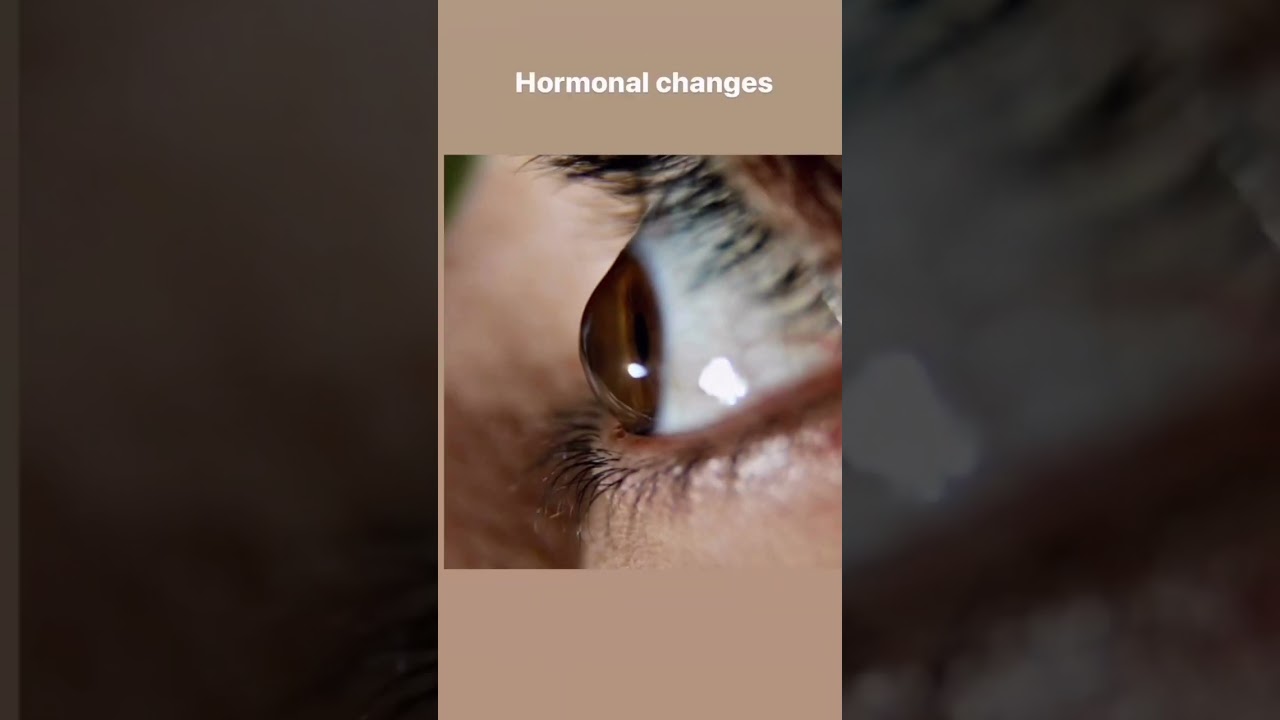 Common eye finding Did you know your eyes reveal more than you think? 