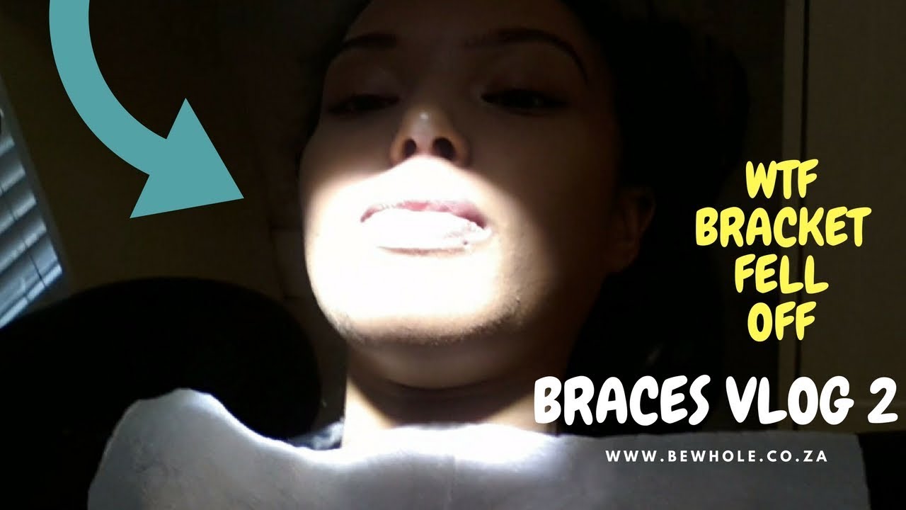 Adult braces update // vlog 2 // Robyn Ruth Thomas (4 mins) YouTube