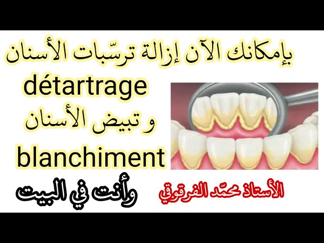 الآن بإمكانك إزالة ترسبات الأسنان Détartrage و تبييض الأسنان Blanchiment وأنت في البيت بكل سهولة