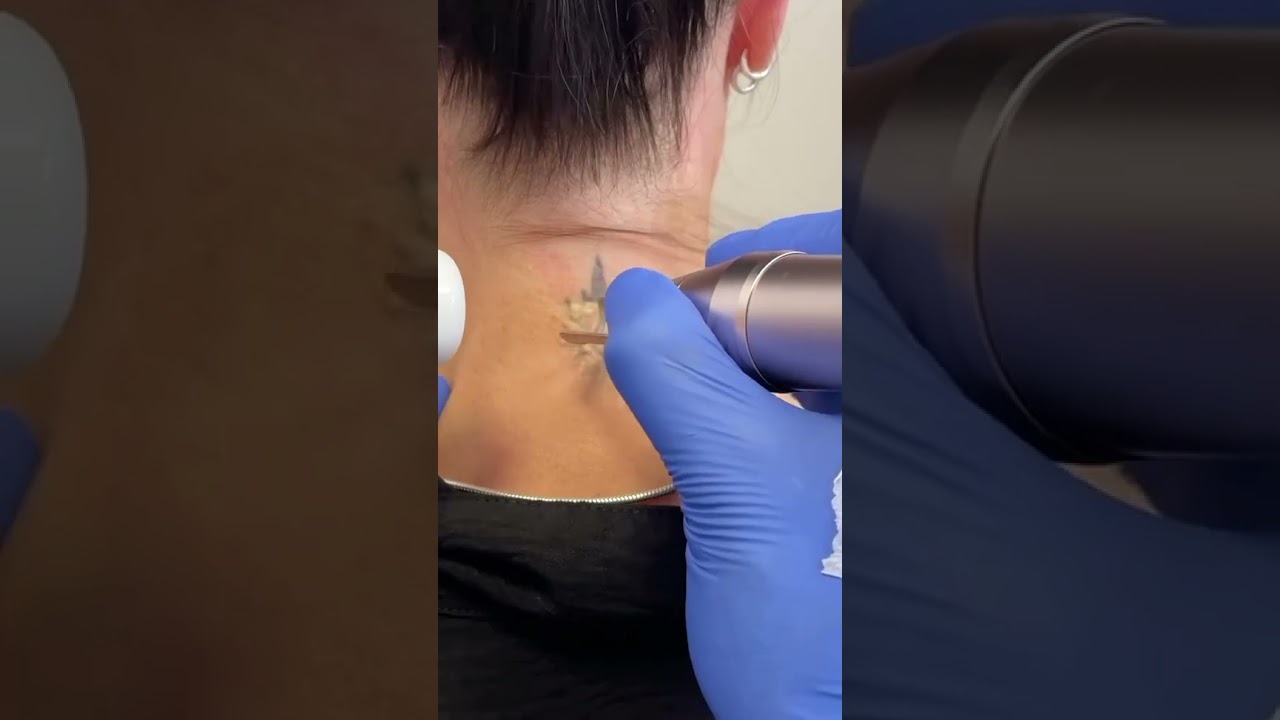 removing tattoo 