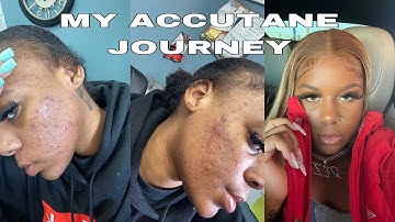 MY ACCUTANE JOURNEY | tips + pictures, how to get clear skin, being transparent, my experience