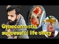 gynecomastia successful life story / kombameesha  / real story