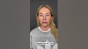Как фейслифтинг и платизмопластика меняет людей😍 Доктор БЛОХИН С.Н.