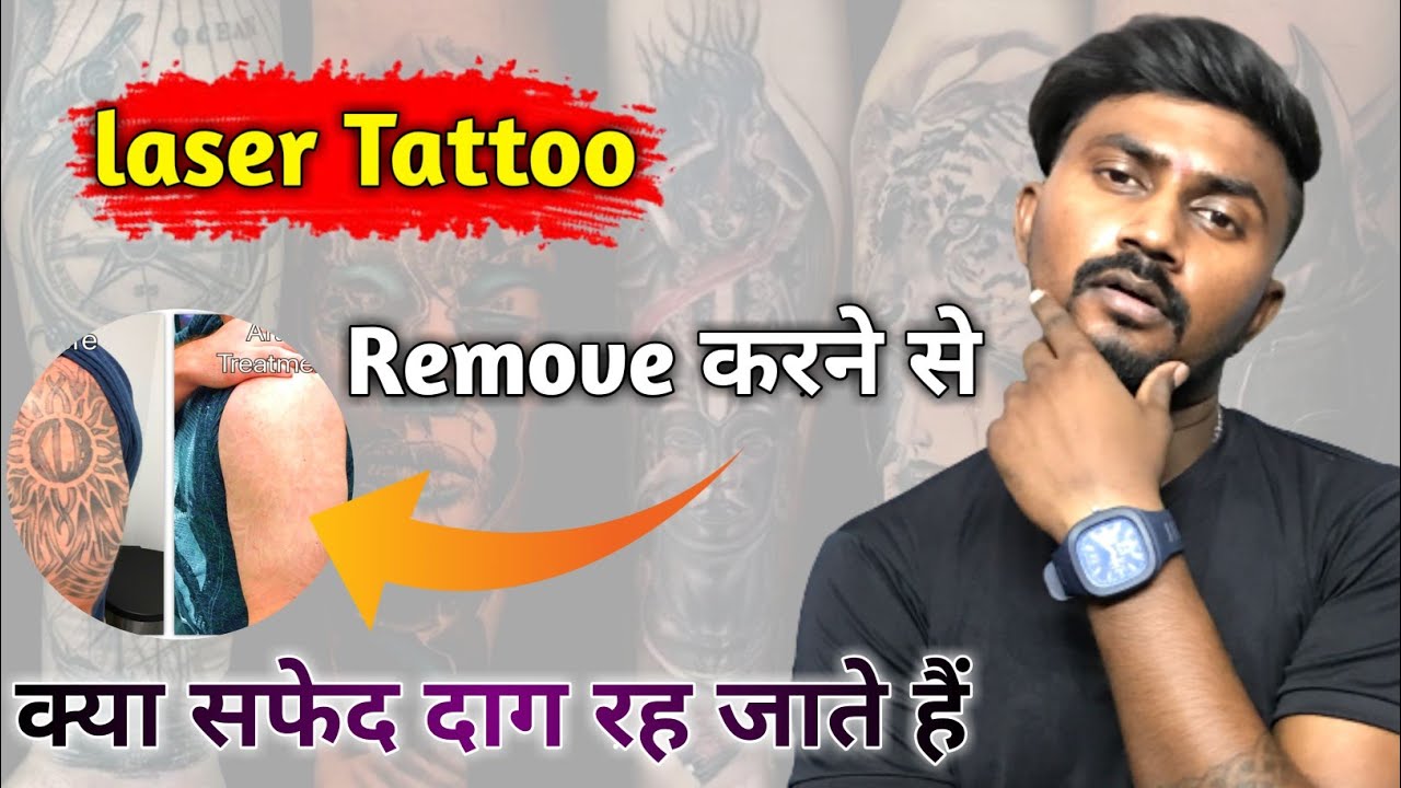 laser Treatment For Tattoo Removal🤫 laser treatment side effect in