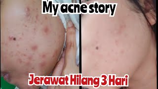 Acne Story Jerawat Parah Hilang Dalam 3 hari #ACNEFIGHTER