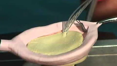 Capsular Shift / Labrum Repair Sawbones Demonstrat...