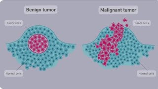 subject pathology, topic, difference between Benign and malignant tumor.