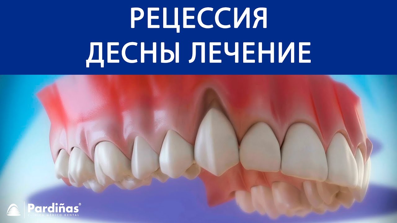 Что Такое Десна Фото Что Такое Десна Фото