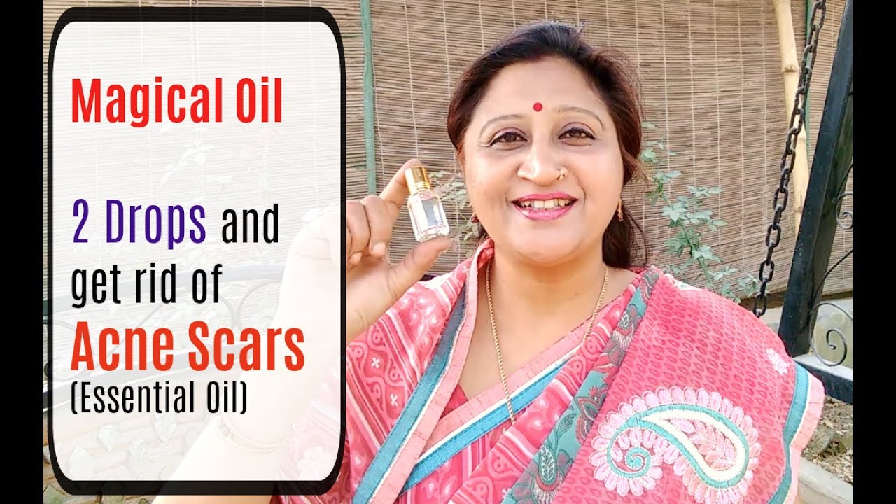 How to get rid of Acne | Pimples | Scars naturally treatment at home by