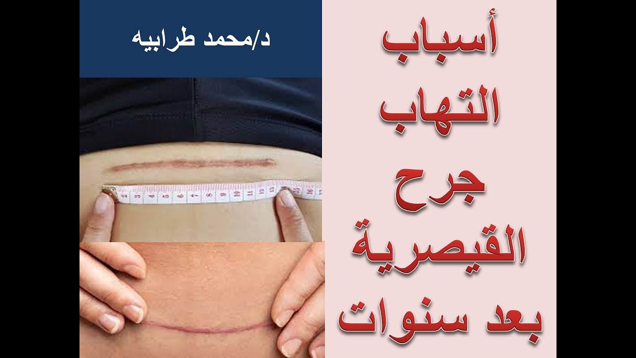 اسباب وعلاج ألم القيصرية بعد سنوات من الولادة.#دكتور_محمد_طرابيه .#عيادة_دكتور_محمد_سعد_طرابيه