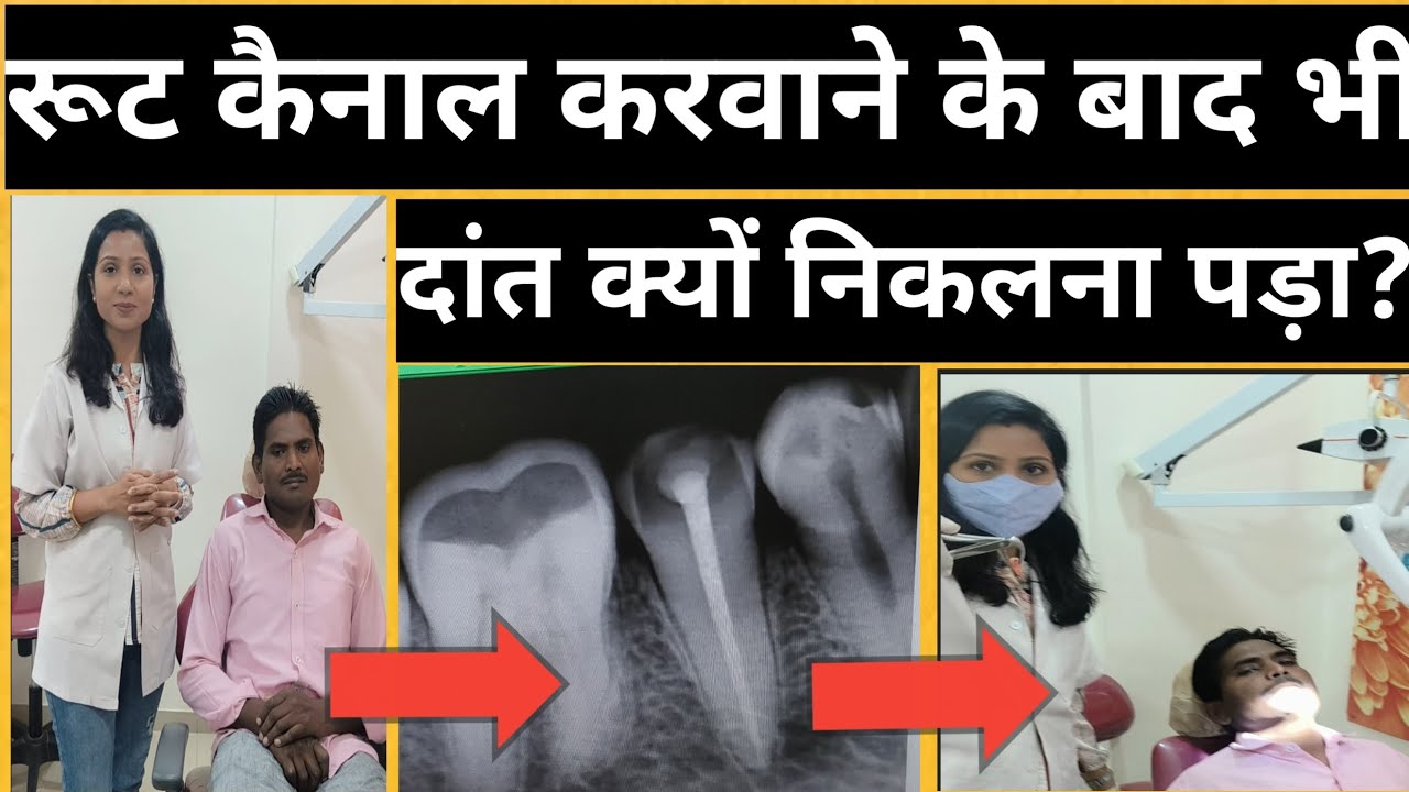 Root Canal Karvaye Ya Nahi Cost Of root canal karvaye ya nahi cost of
